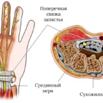 Туннельный синдром