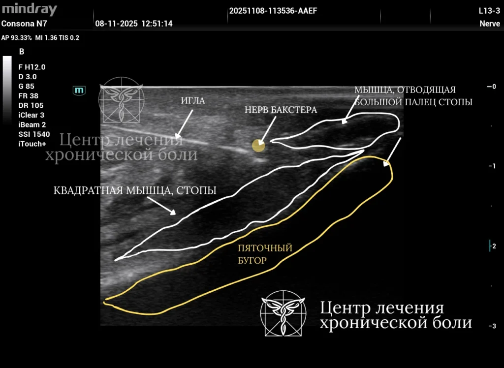 Медикаментозные блокады под УЗ контролем